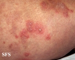 dermatitis herpetiformis