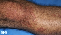 dermatitis herpetiformis