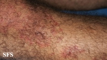 dermatitis herpetiformis