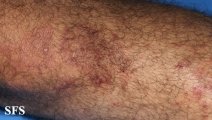 dermatitis herpetiformis