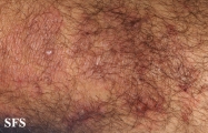dermatitis herpetiformis