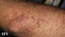 dermatitis herpetiformis