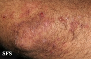 dermatitis herpetiformis