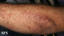 dermatitis herpetiformis