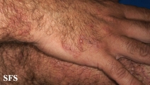 dermatitis herpetiformis