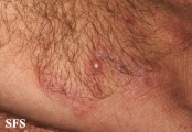 dermatitis herpetiformis
