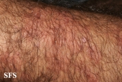 dermatitis herpetiformis