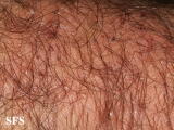 dermatitis herpetiformis