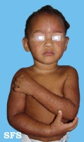 acrodermatitis infantile papular