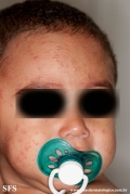 acrodermatitis infantile papular