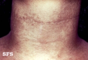 papilomatosis confluentes and reticulate