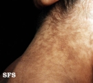 papilomatosis confluentes and reticulate
