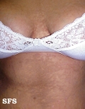 papilomatosis confluentes and reticulate