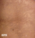 papilomatosis confluentes and reticulate