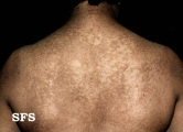 papilomatosis confluentes and reticulate