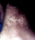 papilomatosis confluentes and reticulate