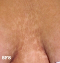 papilomatosis confluentes and reticulate