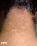 papilomatosis confluentes and reticulate