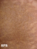 papilomatosis confluentes and reticulate