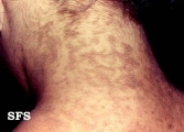 papilomatosis confluentes and reticulate