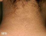 papilomatosis confluentes and reticulate