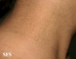 papilomatosis confluentes and reticulate
