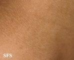 papilomatosis confluentes and reticulate