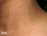 papilomatosis confluentes and reticulate