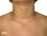 papilomatosis confluentes and reticulate