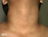 papilomatosis confluentes and reticulate