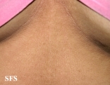 papilomatosis confluentes and reticulate