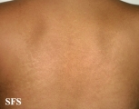 papilomatosis confluentes and reticulate