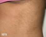 papilomatosis confluentes and reticulate