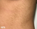 papilomatosis confluentes and reticulate
