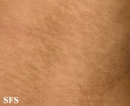 papilomatosis confluentes and reticulate