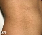 papilomatosis confluentes and reticulate