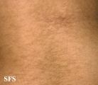 papilomatosis confluentes and reticulate