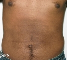 papilomatosis confluentes and reticulate