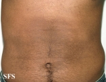 papilomatosis confluentes and reticulate