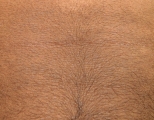 papilomatosis confluentes and reticulate
