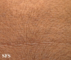 papilomatosis confluentes and reticulate