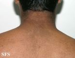 papilomatosis confluentes and reticulate