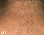 papilomatosis confluentes and reticulate
