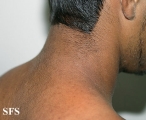 papilomatosis confluentes and reticulate