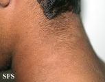 papilomatosis confluentes and reticulate