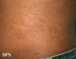 papilomatosis confluentes and reticulate