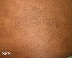 papilomatosis confluentes and reticulate