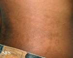papilomatosis confluentes and reticulate