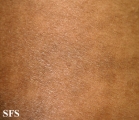 papilomatosis confluentes and reticulate