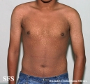 papilomatosis confluentes and reticulate